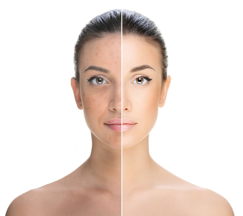 Laser Genesis treatment at Medipro Clinics