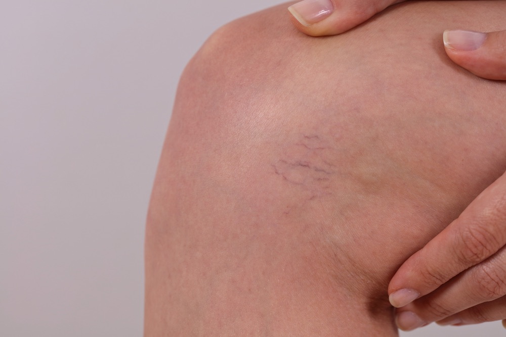 Laser vein treatment at Medipro Clinics